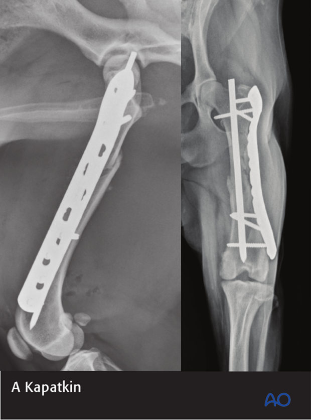 plate and rod