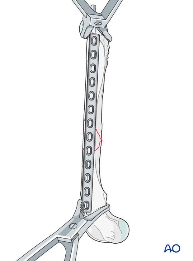 bridging plate and alternative double plating