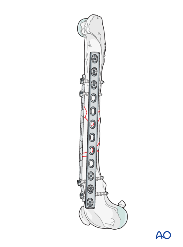 bridging plate and alternative double plating