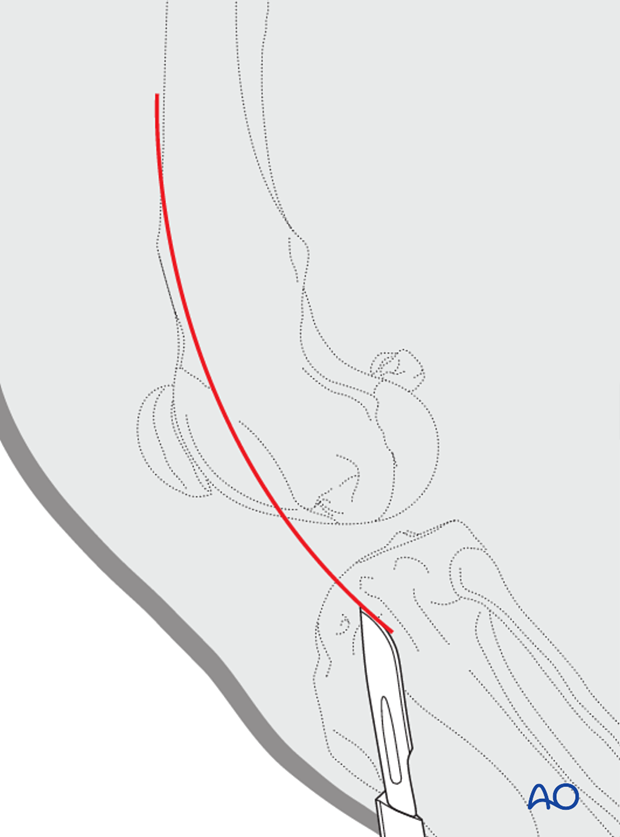 D33_A00_i060 Skin incision for lateral parapatellar approach to dog distal femur