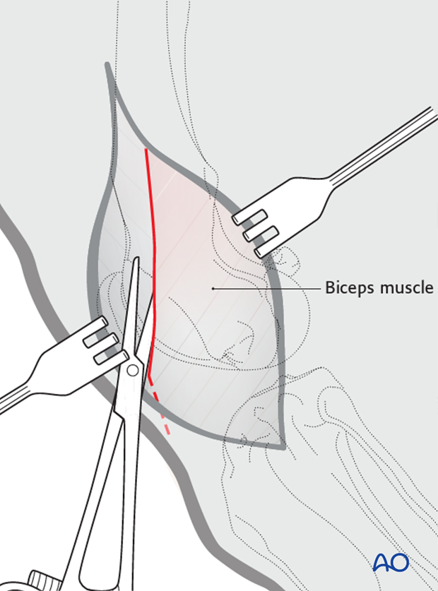 Lateral fascia incision for lateral parapatellar approach to dog distal femur