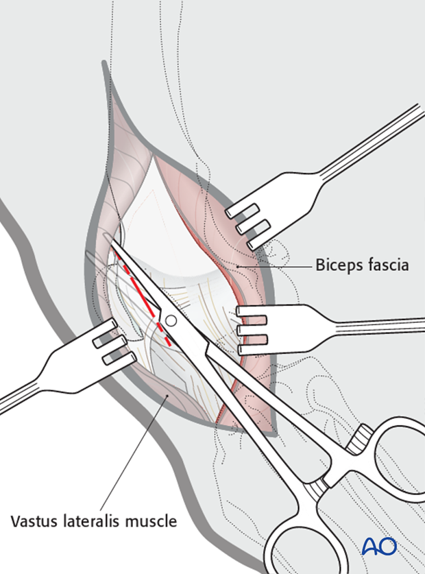 Capsule incision for dog tibial tuberosity osteotomy