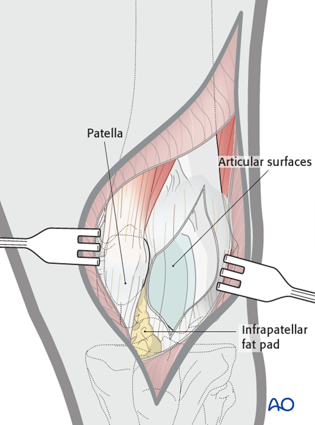 Exposure of articular surfaces for dog tibial tuberosity osteotomy