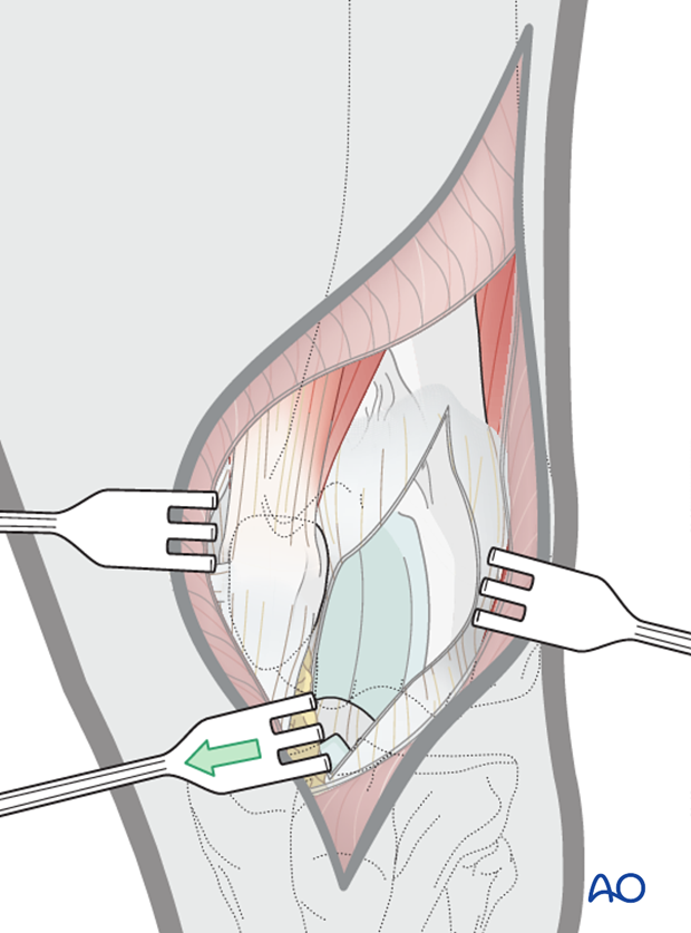 D33_A00_i140 Lateral parapatellar approach to dog distal femur