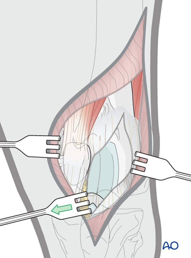 Lateral parapatellar approach to the cat distal femur