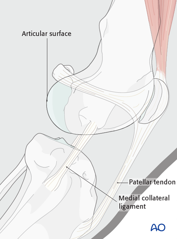 Key anatomic landmarks to be identified prior to the medial parapatellar approach to the dog distal femur