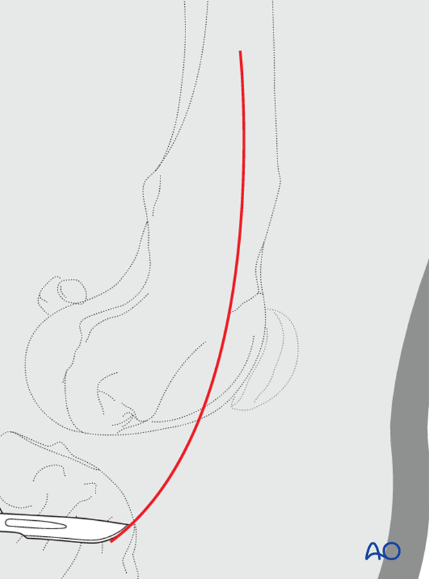 Incision for medial parapatellar approach to the dog distal femur