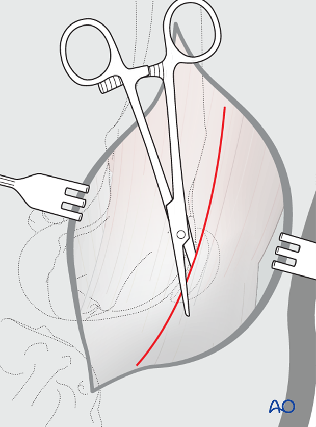 Fascia incision for medial parapatellar approach to the dog distal femur