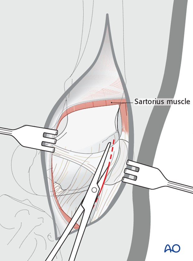 Capsule incision for medial parapatellar approach to the dog distal femur