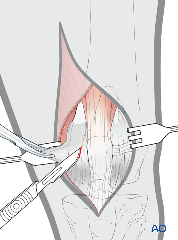 Grasp and tent the joint capsule with forceps prior to the stab incision for medial parapatellar approach to the dog distal femur