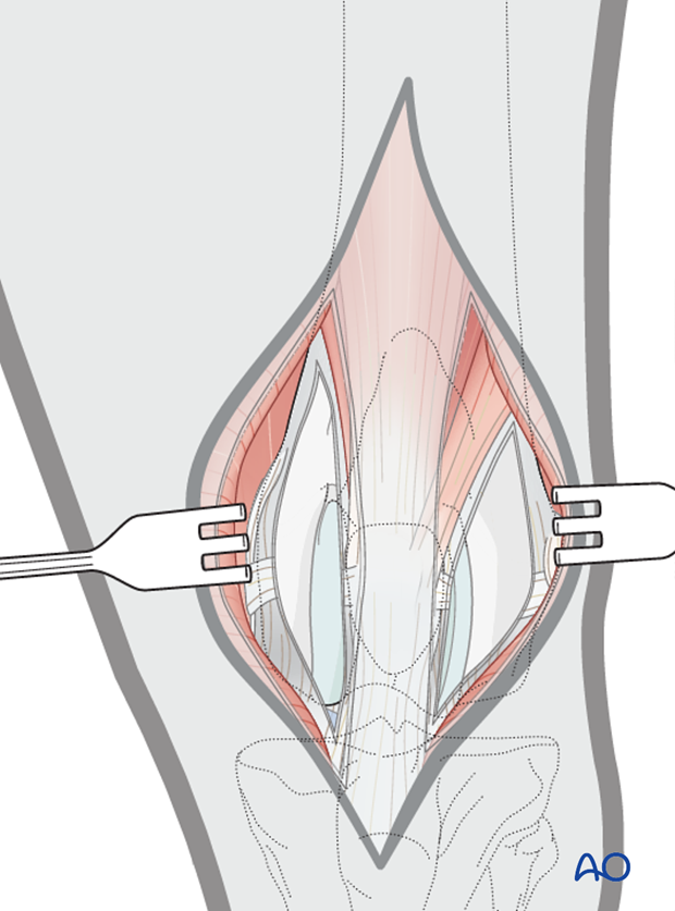 The bilateral approach to the dog distal femur provides adequate visualization of the articular surface of the femoral condyle