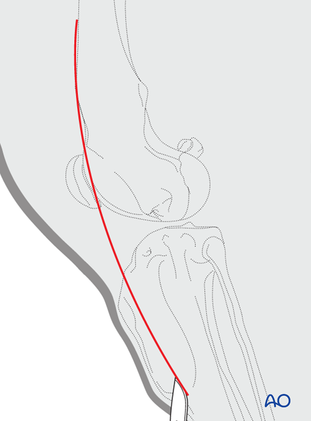 Incision for dog tibial tuberosity osteotomy