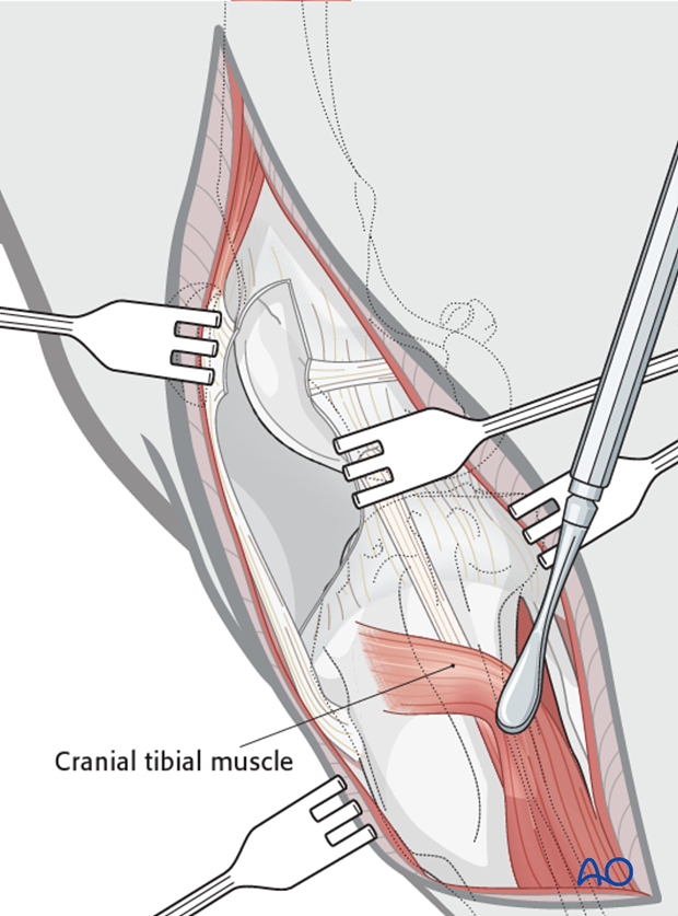 The cranial tibial muscle is reflected caudally to avoid damage during the dog tibial tuberosity osteotomy