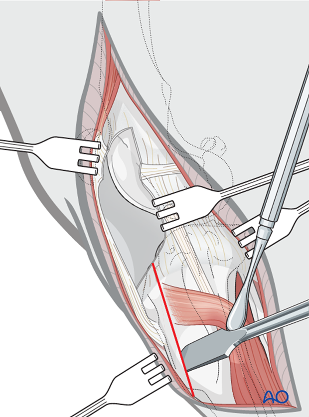 An osteotomy of the tibial crest is performed with an osteotome and mallet, while a periosteal elevator is used to retract the cranial tibial muscle