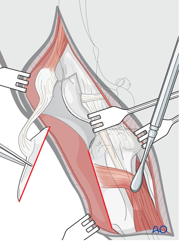 The dog tibial crest is reflected proximally for exposure of the intraarticular structures