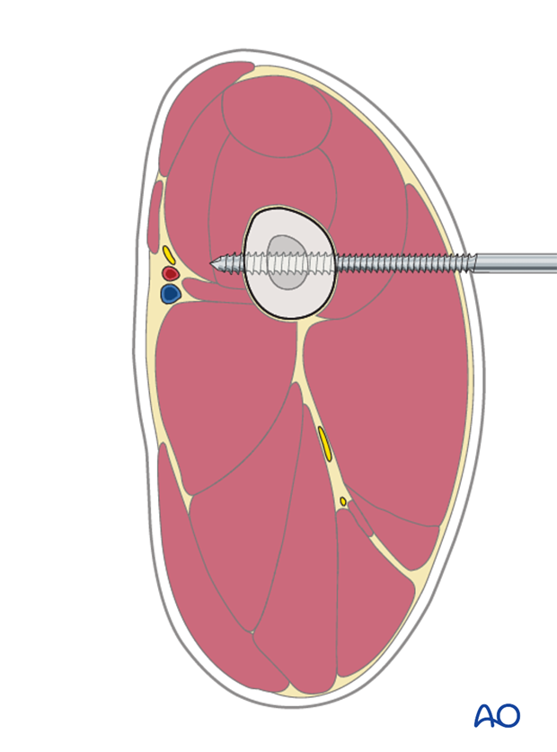 External fixators can be successfully used to treat dog femoral fractures