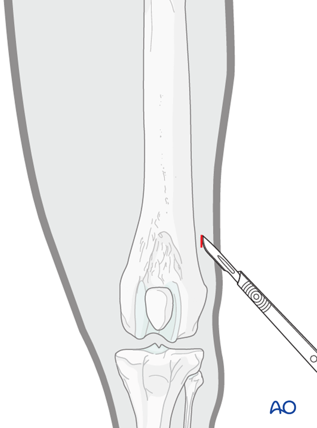 Incision for external fixators pin placement to treat dog femoral fractures