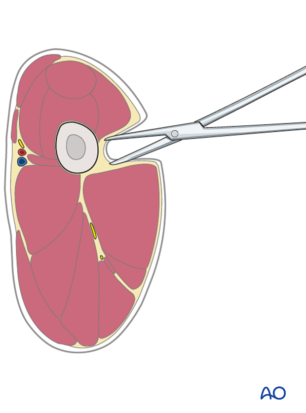 Dissection for external fixators pin placement to treat dog femoral fractures