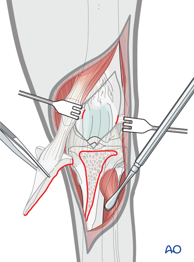 The tibial tuberosity osteotomy provides adequate visualization of the articular surface of the femoral condyle of the dog distal femur