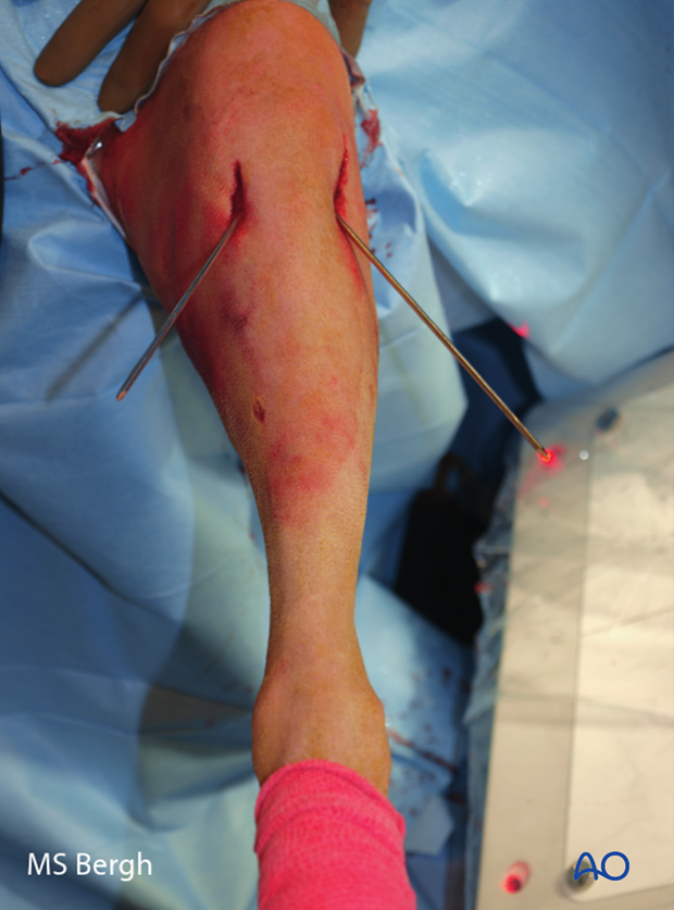 D33_A00_i580 Percutaneous approach pin placement in dog distal femur