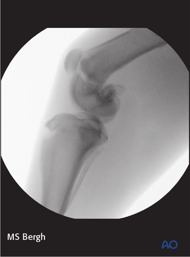 D33_A00_i640 Fluoroscopy or intraoperative radiography is used to ensure appropriate reduction with percutaneous approach in dog distal femur