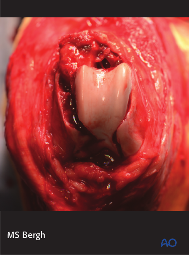 D33_A00_i660 The lateral parapatellar approach to dog distal femur provides adequate visualization of both femoral condyles and fracture lines