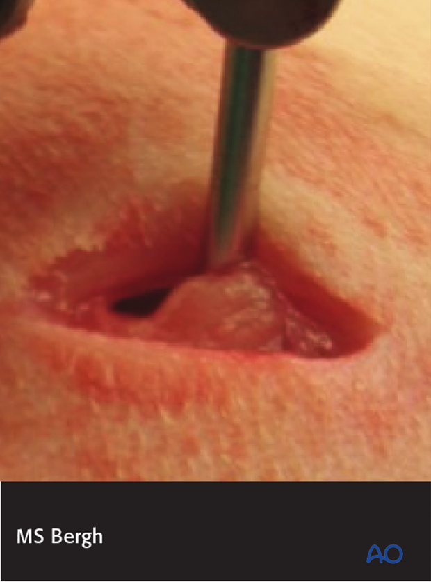 safe zones for external skeletal fixator