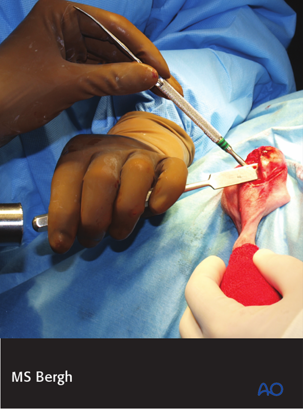 tibial crest osteotomy