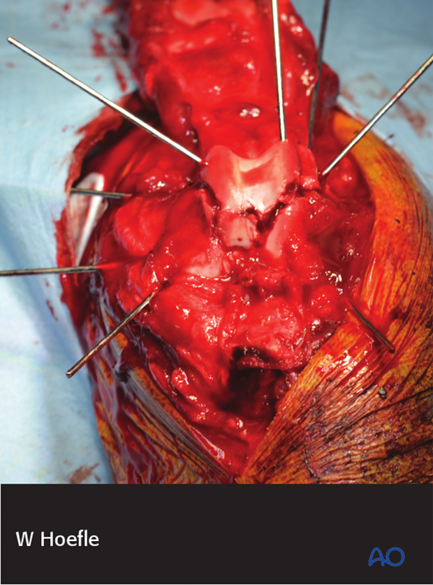 tibial crest osteotomy