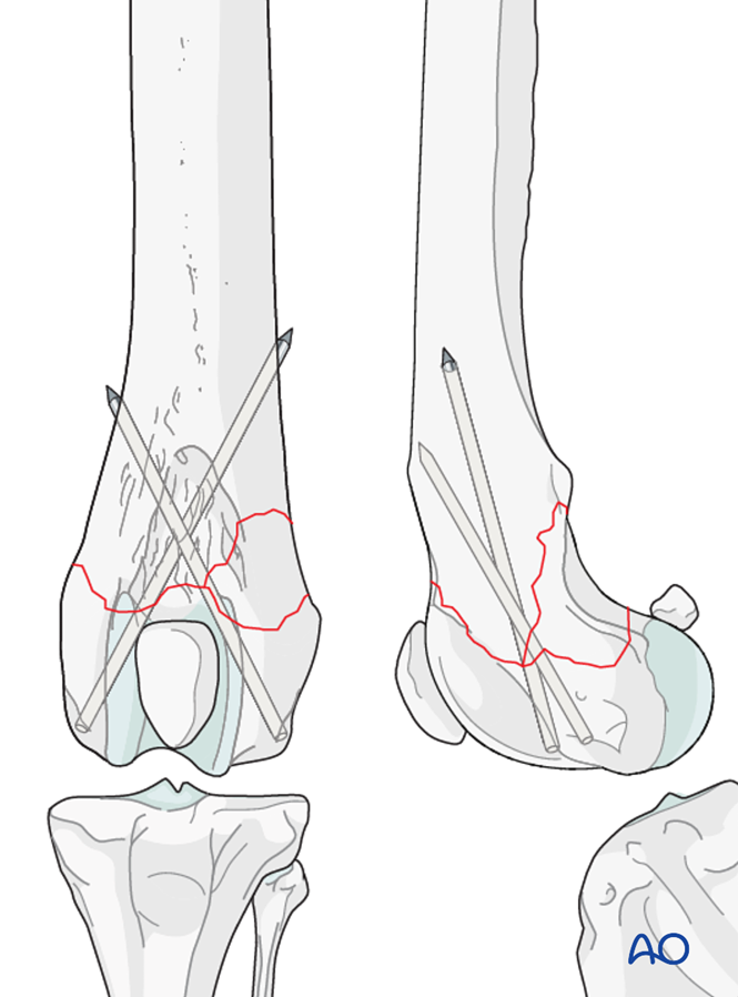 Cross pinning for Extraarticular fracture, wedge