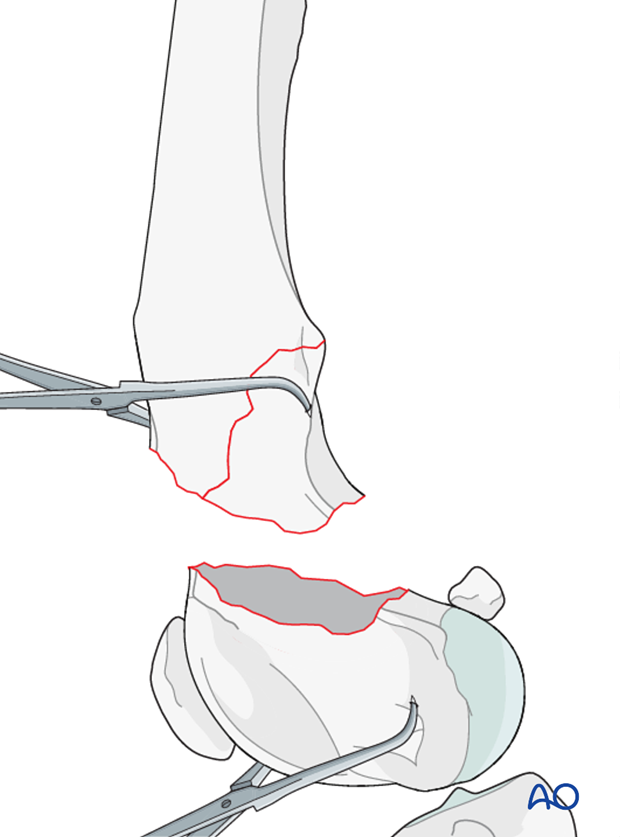 The fracture of the dog distal femur may be alternatively reduced with pointed reduction forceps on each fragment