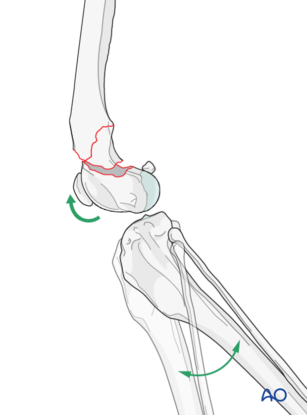 Achieving partial reduction of the fracture and gently extending the stifle joint may aid reduction