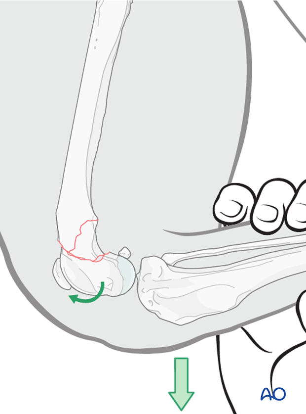 With the femur of the dog stabilized, the tibia is pulled cranially, which is used to push the distal fragment into reduction