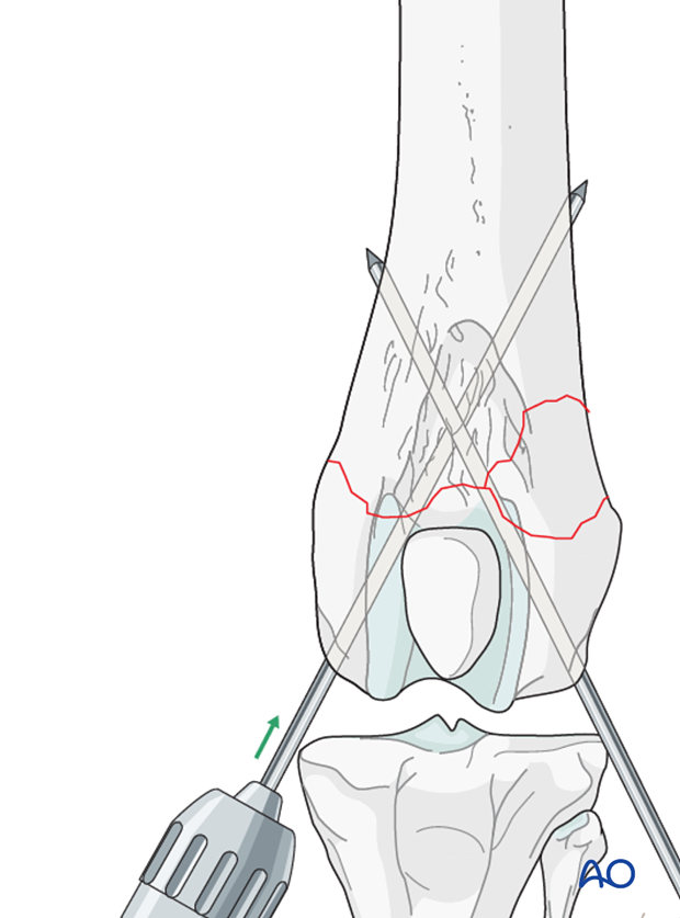 Two Steinmann pins or K-wires are driven obliquely across the fracture plane to cross each other proximal to the fracture