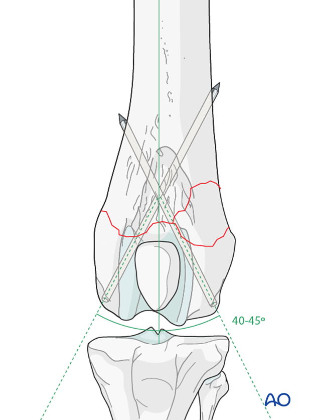Both pins should be 40-45 degrees to the long axis of the femur