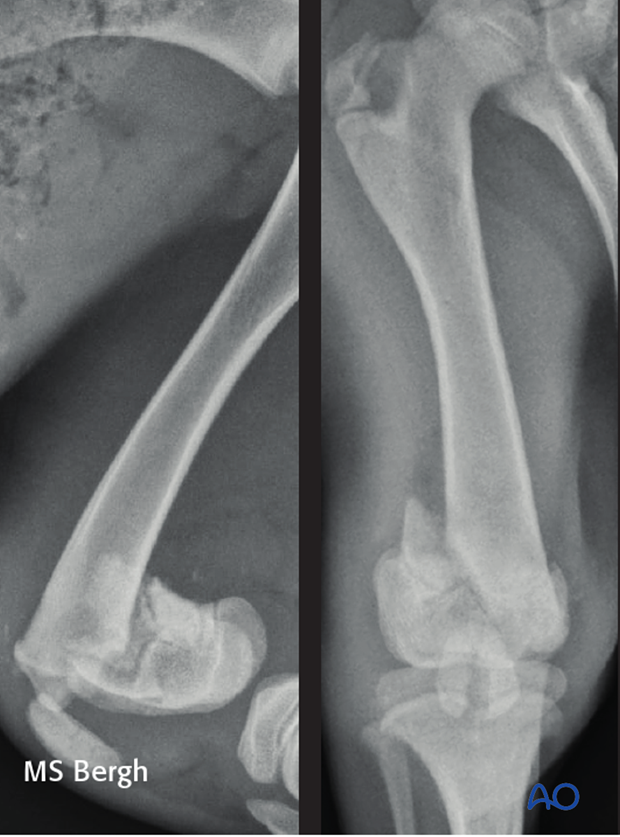 Radiograph of a 5.5-month-old mixed breed dog with a 33-A2 fracture and a sagittal fracture of the patella