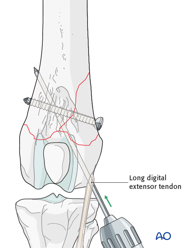 D33_P110_i100 Two Steinmann pins or K-wires are driven obliquely across the fracture plane to cross each other proximal to the fracture
