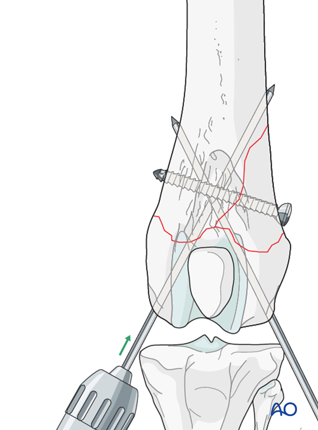 D33_P110_i120 Two Steinmann pins or K-wires are driven obliquely across the fracture plane to cross each other proximal to the fracture