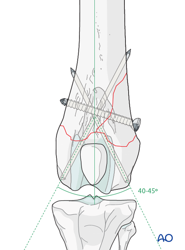 D33_P110_i140 Both pins should be 40-45 degrees to the long axis of the femur