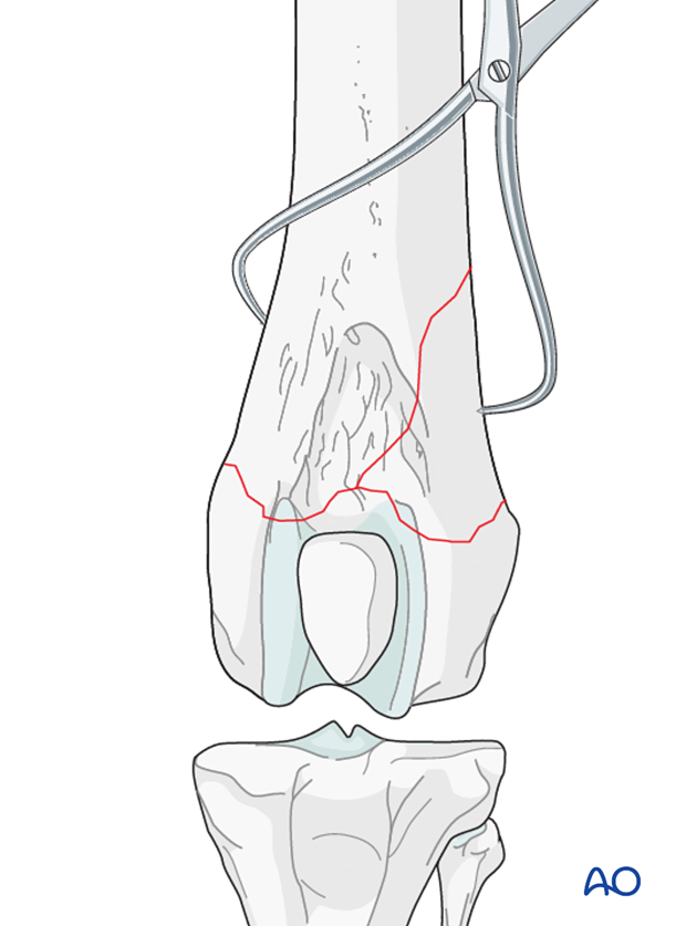 D33_P110_i220 preliminary stabilization is achieved with forceps placed across the wedge fracture in the metaphysis