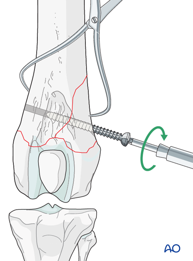 D33_P110_i240 A screw is inserted in lag fashion, perpendicular to the fracture line