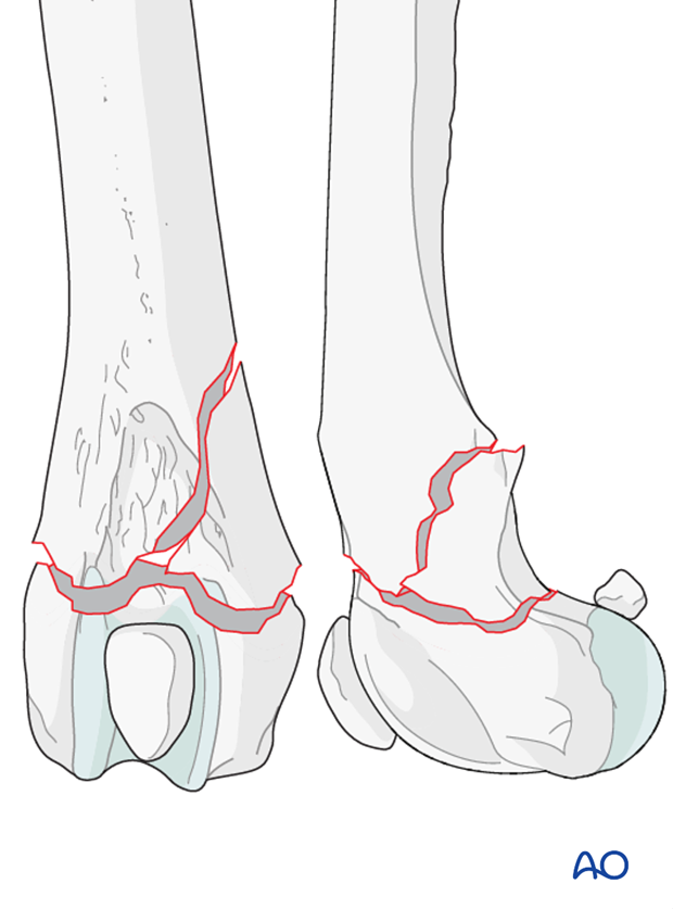 D33_P110_i260 Type A2 fracture in a dog distal femur