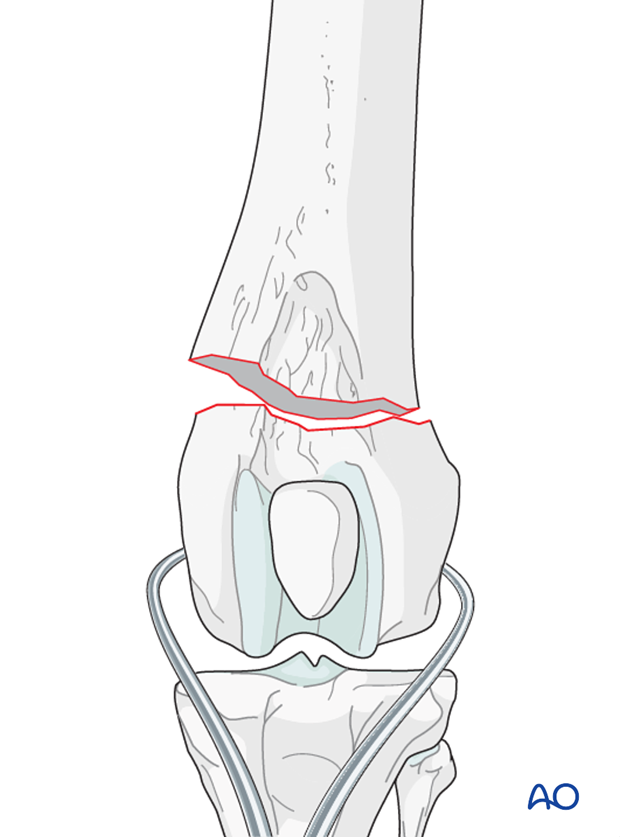 D33_P120_i040 The fracture of a dog distal femur is reduced with pointed reduction forceps on each fragment