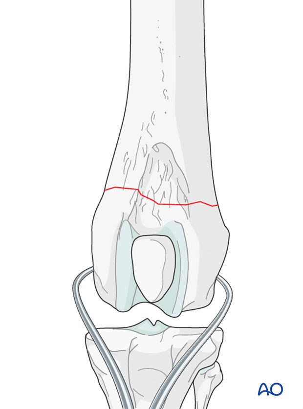 D33_P120_i060 Anatomic reconstruction is desirable