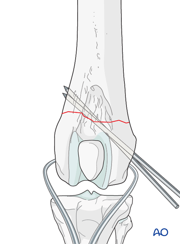 D33_P120_i080 Preliminary stabilization can be achieved with reduction forceps or K-wires
