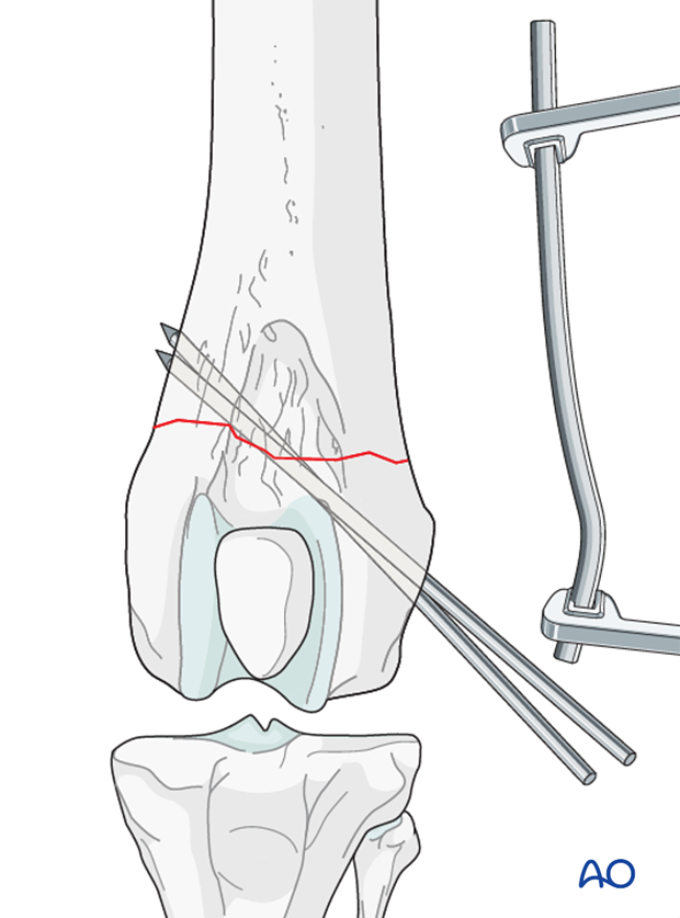 D33_P120_i120 The plate is contoured to the lateral aspect of the distal femur