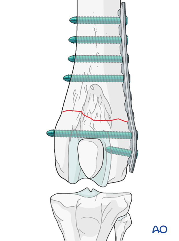 D33_P120_i180 If a locking plate is used, only 2-3 locking bicortical screws are needed per main fragment