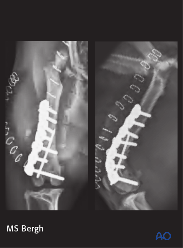 D33_P120_i200 Postoperative radiograph of a dog with a 33-A1 fracture, comminuted acetabular fracture, and sacroiliac luxation repaired using a reconstruction plate and a K-wire