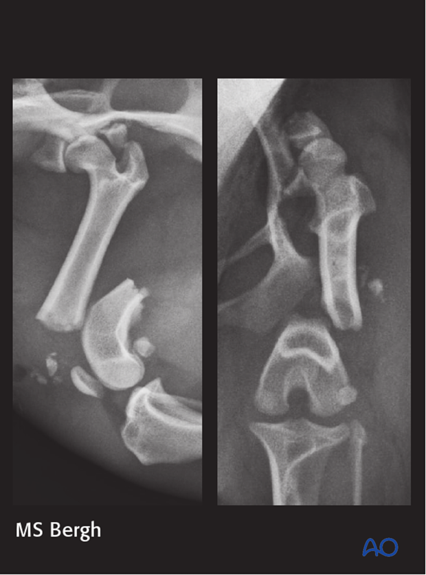 D33_P120_i220 2-year-old small mixed breed dog presented with a left grade 1 open 33-A1 fracture, comminuted acetabular fracture, and sacroiliac luxation