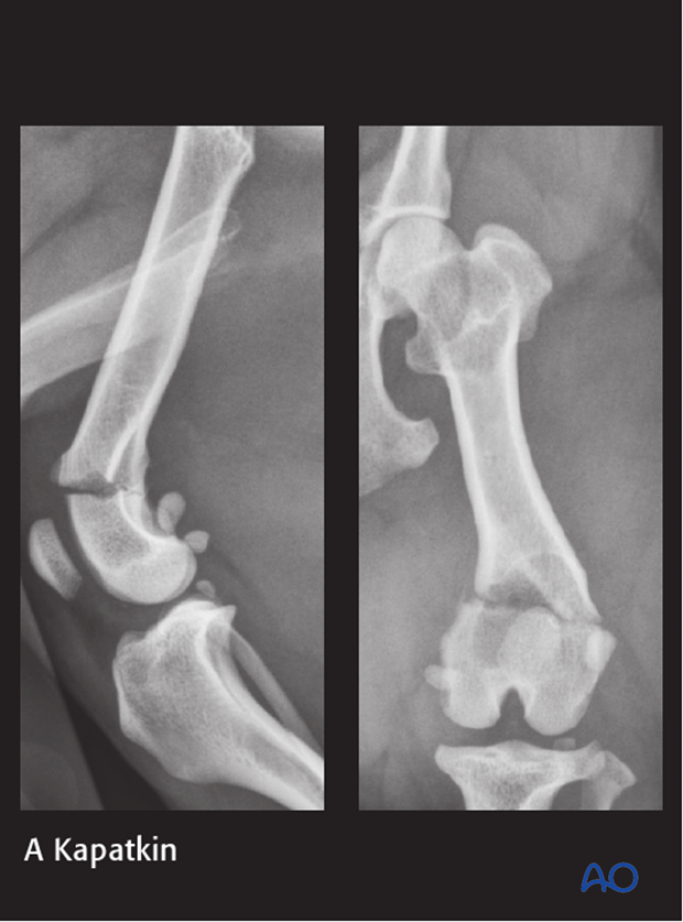 D33_P120_i240 plate fixation